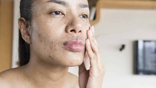 Pele com Manchas: tratamento e prevenção na rotina de skincare