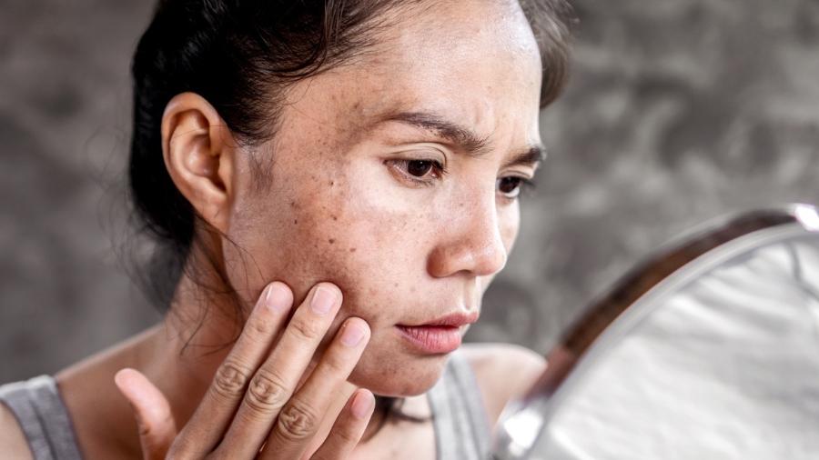Pele com Manchas: tratamento e prevenção na rotina de skincare