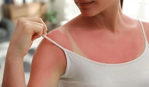 5 Cuidados Básicos para Proteger a Pele Durante o Verão