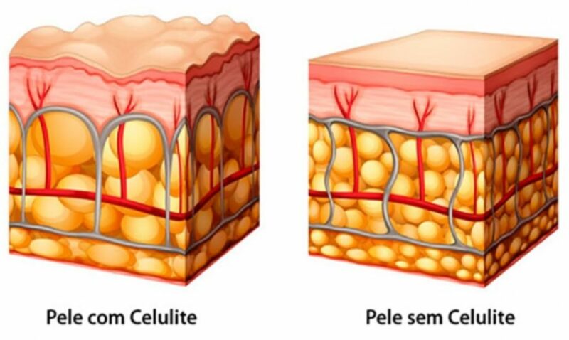 Dimpless: Como o antioxidante oriundo do Melão reduz a celulite