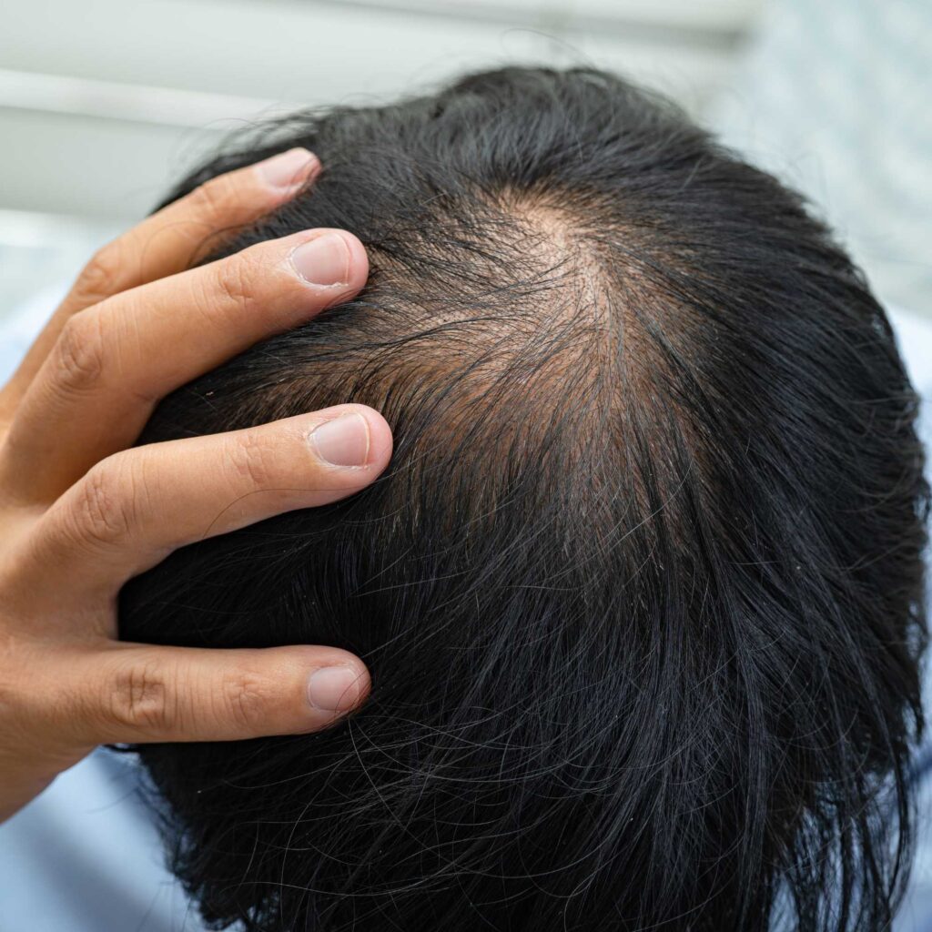 Minoxidil-crescimento-cabelo-barba