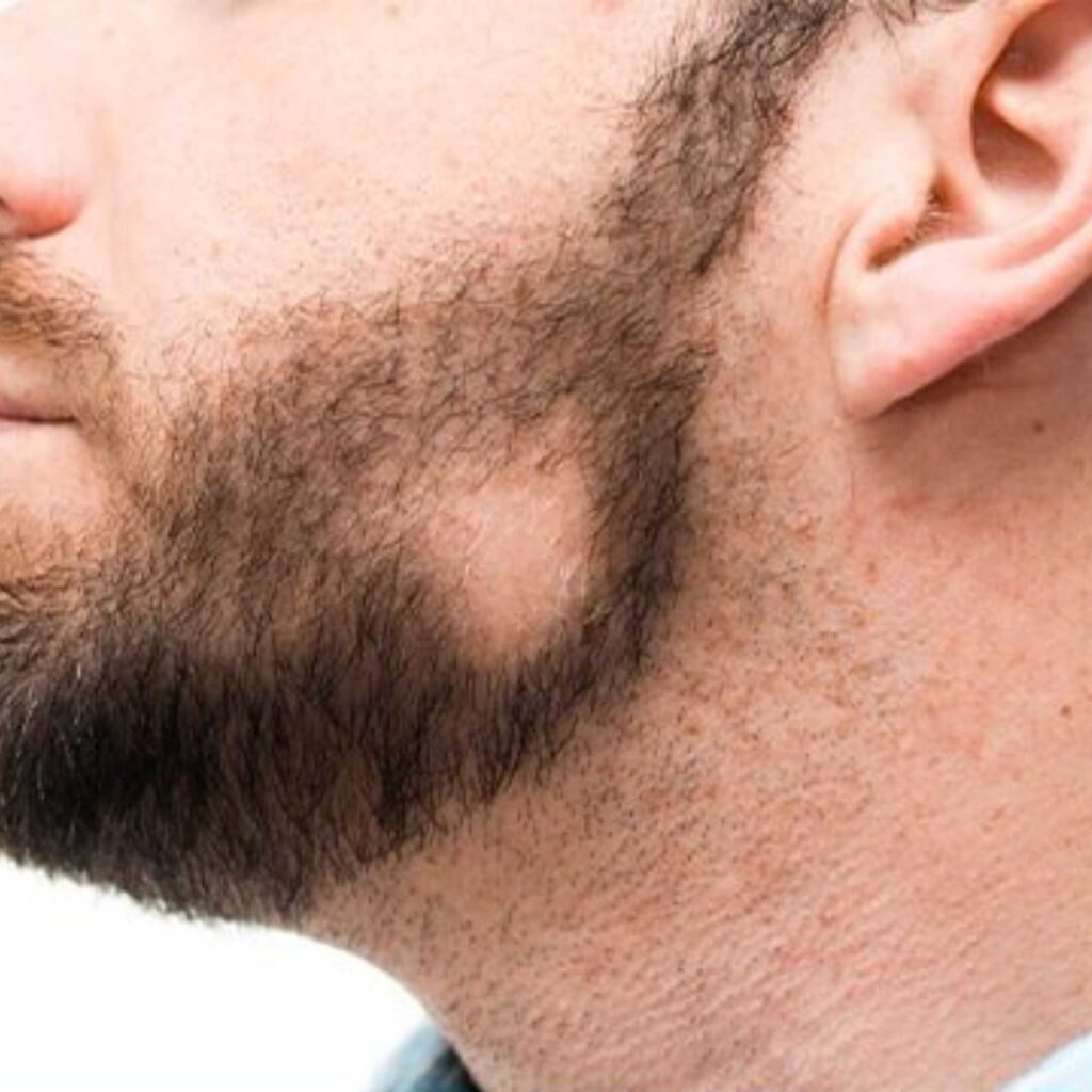 Minoxidil-crescimento-cabelo-barba