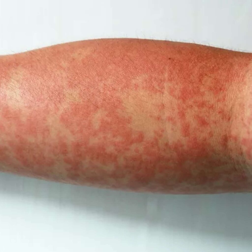 Dengue: Como Identificar os Sintomas e se Proteger da Doença